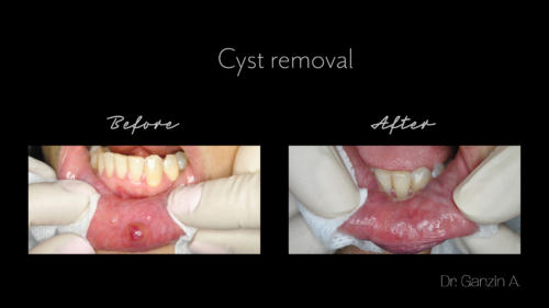 Cyst removal