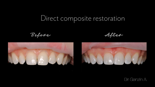 Direct composite restoration