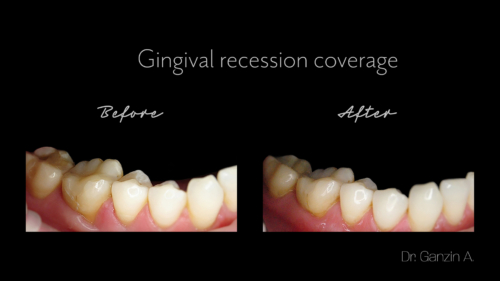 Gingival recession coverage