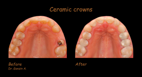 Ceramic crowns